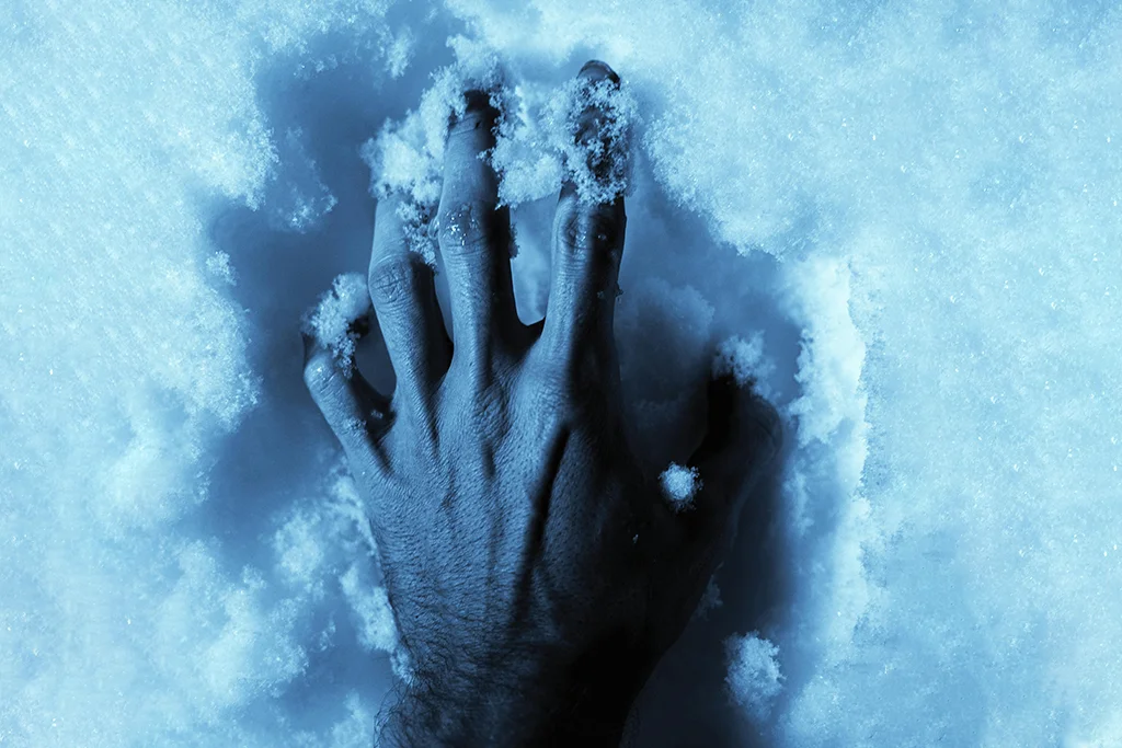 snow burned hand