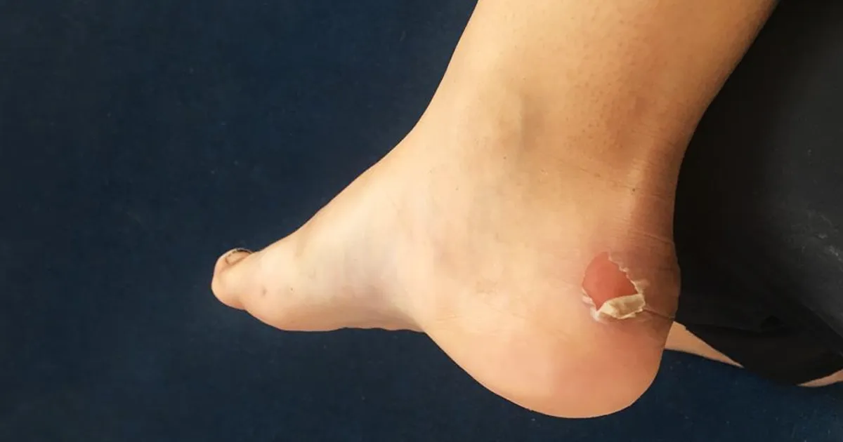 Blisters in Everest Trekking