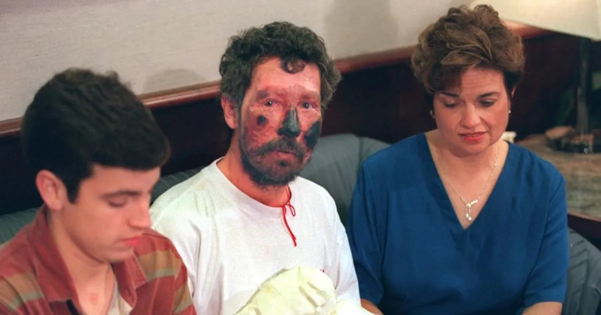 Frost Bite in Everest